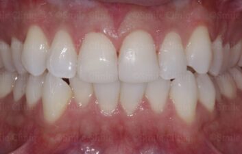 whitening and cosmetic bonding after