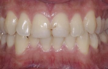 whitening and cosmetic bonding before