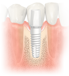 Ceramic Dental Implants