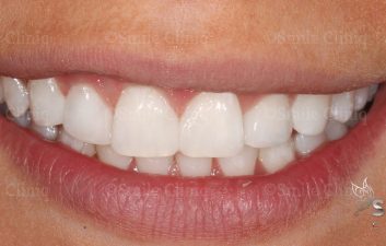 London dentist after whitening and bonding