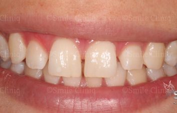 London dentist before whitening and bonding