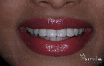 after whitening and bonding st john's wood dentist