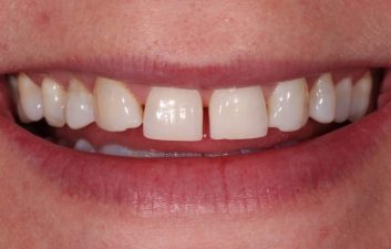 Composite Bonding London Dentist