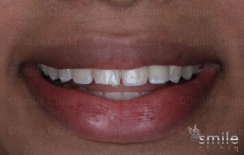 before whitening and bonding st john's wood dentist