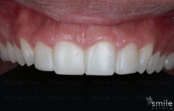 composite bonding london dentist after