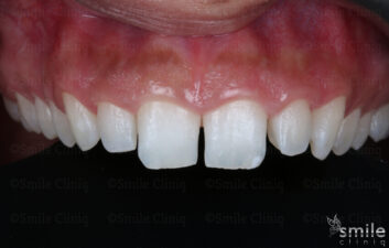 composite bonding london dentist before