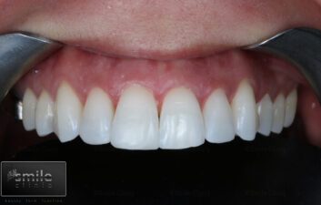 after front teeth composite bonding london dentist 