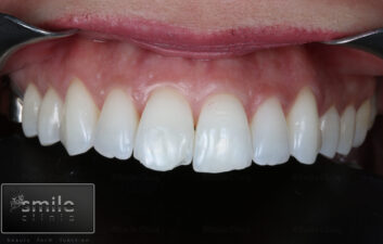 before front teeth composite bonding london dentist