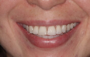 dentist near me composite bonding after