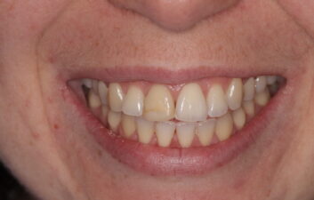 dentist near me composite bonding before