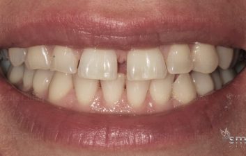 diastema closure before