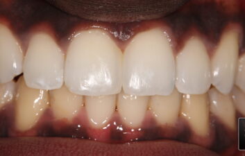 diastema closure composite boding london dentist after 