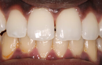 diastema closure composite bonding lonodn dentist before