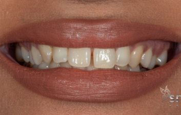 front tooth gap closure bonding before