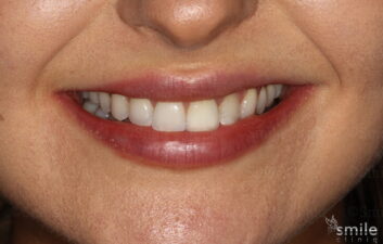 Smile makeover london dentist after