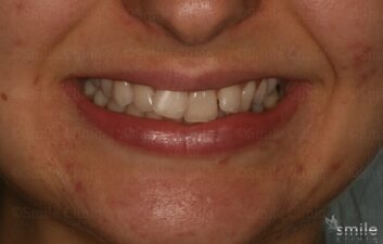 Smile makeover london dentist before