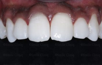 Dark incisor after 