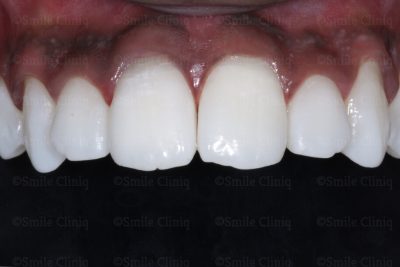 Dark incisor after