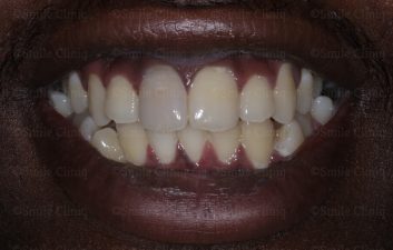 Dark incisor before