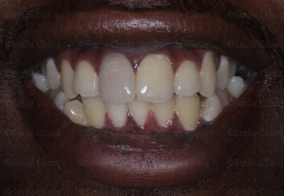 Dark incisor before