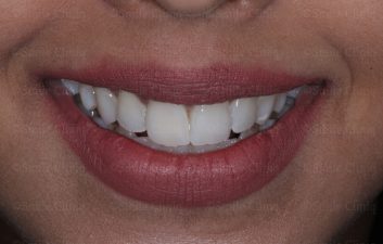 Discoloured central incisor after