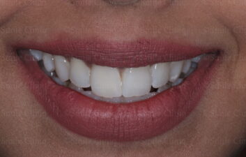 Discoloured central incisor after