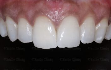 Discoloured central incisor after