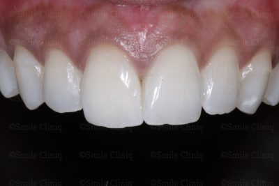 Discoloured central incisor after