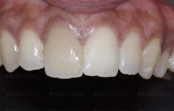 Discoloured central incisor before