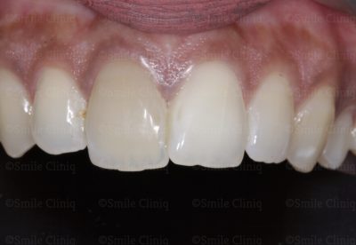 Discoloured central incisor before