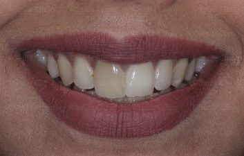 Discoloured central incisor before