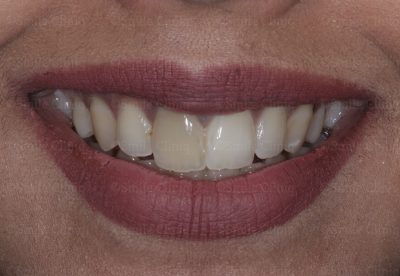 Discoloured central incisor before