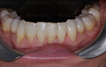Lower teeth Black Triangle Treatment after
