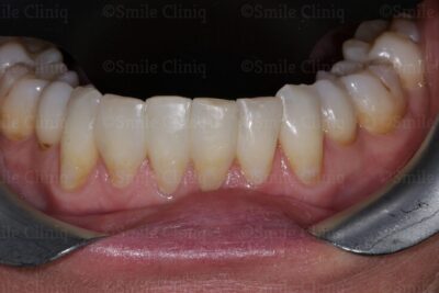Lower teeth Black Triangle Treatment after