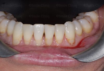 Lower teeth Black Triangle Treatment before