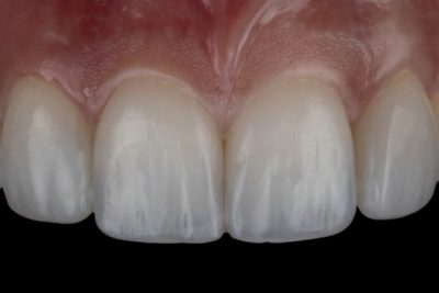 Small or spaced teeth After