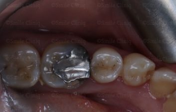 amalgam removal before