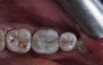 amalgm removal after