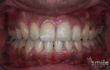 fastbraces london dentist after