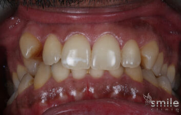 fastbraces london dentist before