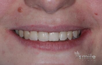 Braces finchley dentist after 