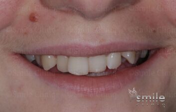 Braces finchley dentist before