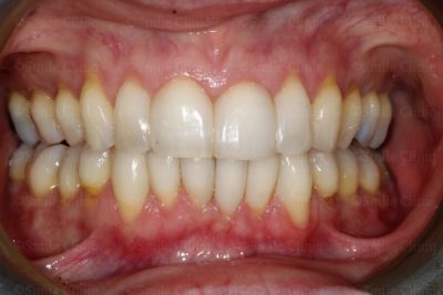 Bioclear Black Trangle Treatment London After