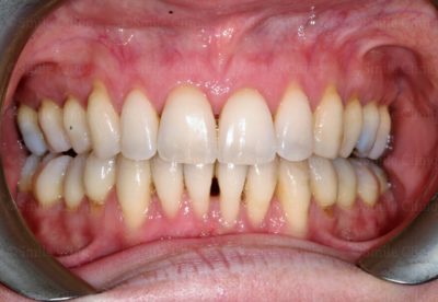 Bioclear Black Trangle Treatment London Before