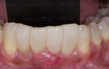 Bioclear lower arch after