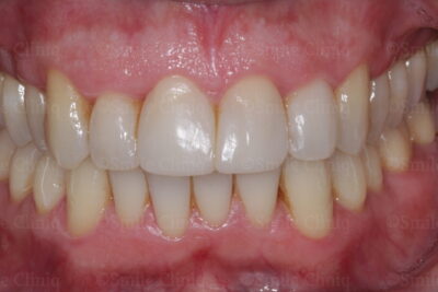 bioclear composite bonding after