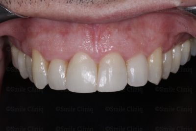 bioclear composite bonding after