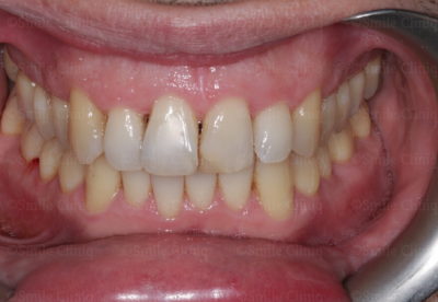 bioclear composite bonding before