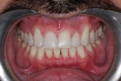 bioclear composite makeover after