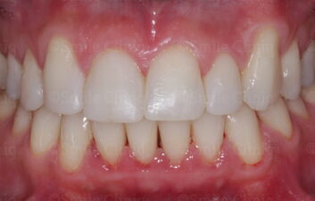bioclear composite makeover after 1
